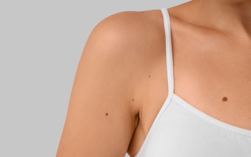 Nốt ruồi là gì?