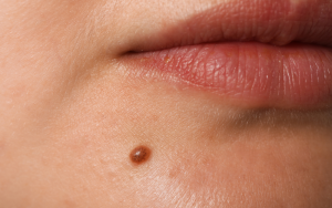 Tìm hiểu nốt ruồi là gì và các loại nốt ruồi phổ biến